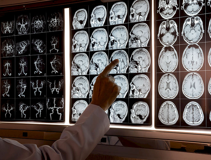 imagen correspondiente a la noticia: "Implementan técnicas avanzadas de neuroimágenes y estimulación cerebral en pacientes con afasia"